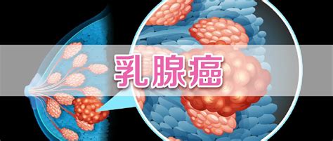 乳房 痣|痣或为乳腺癌的危险因素